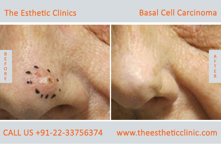 Basal Cell Carcinoma Treatment Surgery before after photos in mumbai india (4)